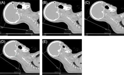 Assessment of different head tilt angles in volumetric modulated arc therapy for hippocampus-avoidance whole-brain radiotherapy